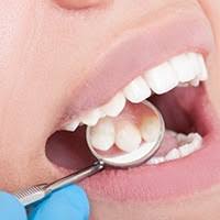 Zubný kaz si vyžaduje včasnú liečbu
